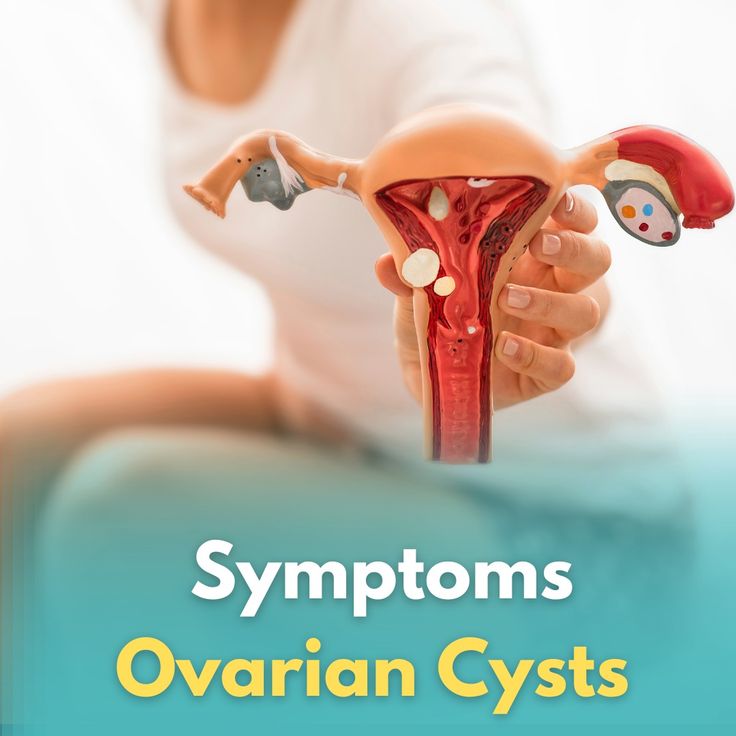 Ovarian Cysts